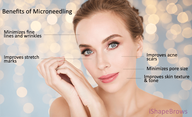 An image depicting some of the benefits of microneedling. Microneedling can reduce fine lines and wrinkles, improve stretch marks, improve acne scars, and improve skin texture and tone.