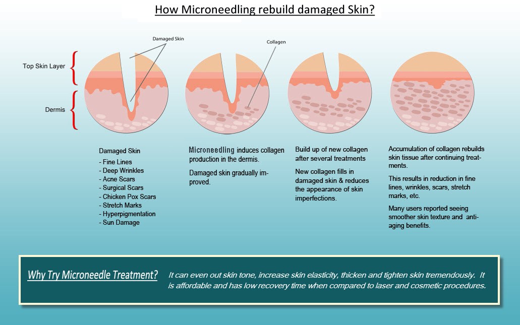 An image displaying how Microneedling works. Microneedling stimulates collagen production by introducing micro perforations in the skin that the skin quickly repairs causing a remodeling and improvement of skin tone.