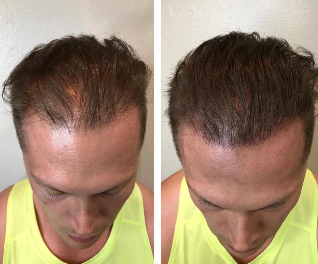 Fixing male thinning hair in this before and after