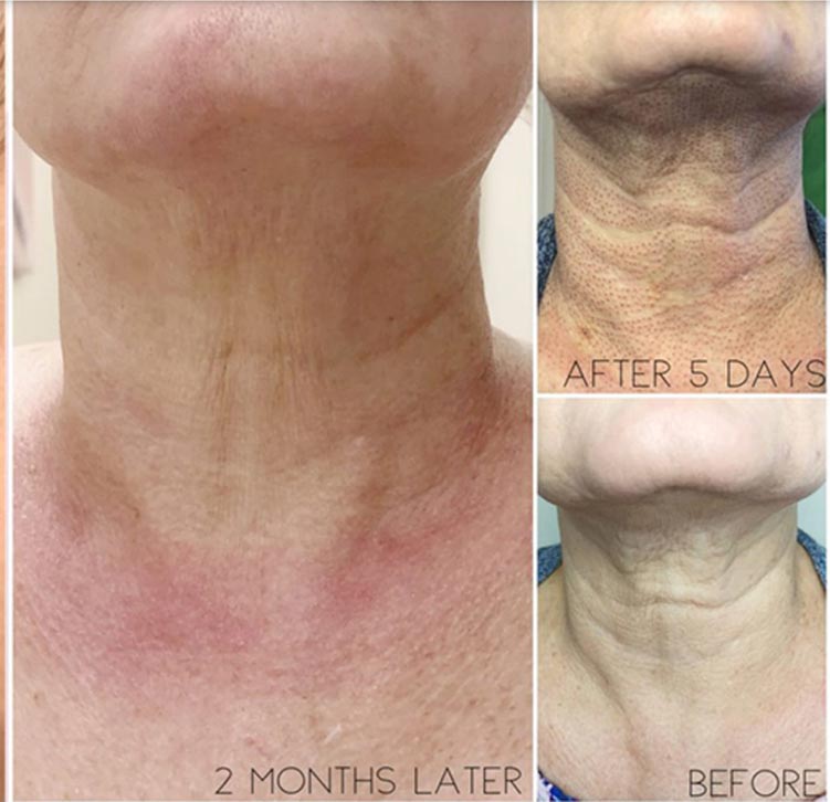Wrinkles removed from the neck area