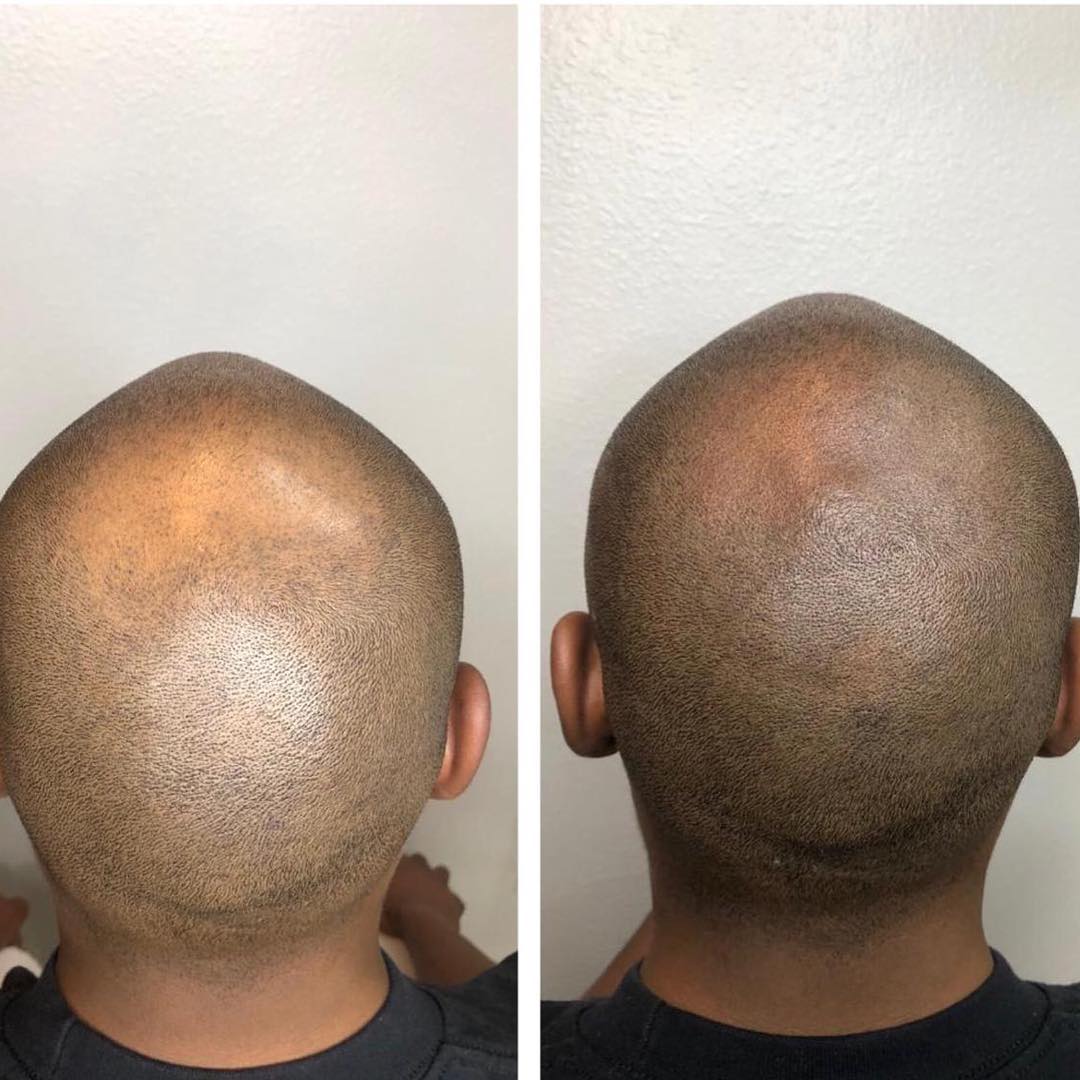 Scalp pigmentation for pattern baldness from Las Vegas iShapeBrows Scalp Micropigmentation artist Fernando Tellez