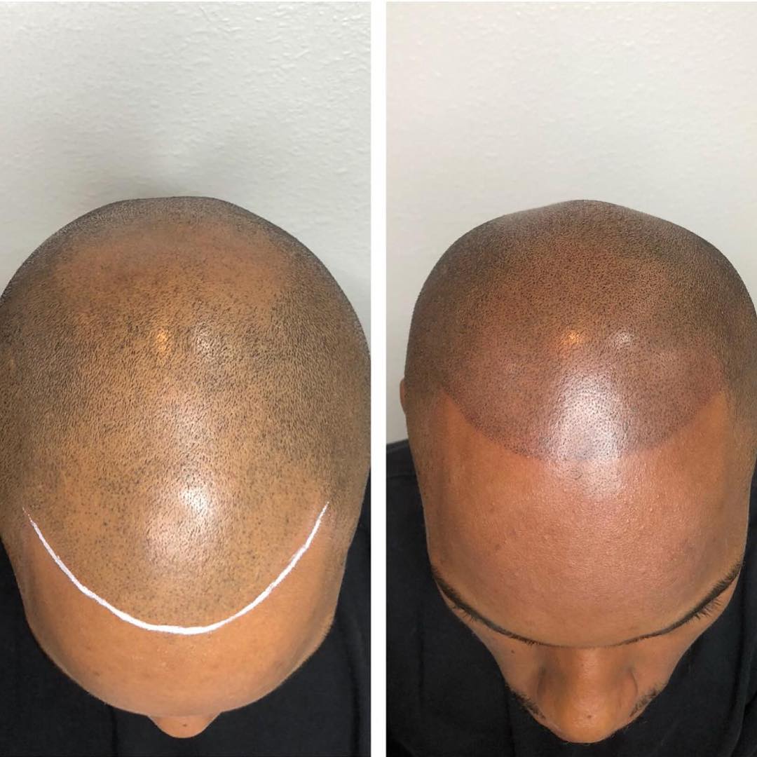 Scalp pigmentation for receding hairline from Las Vegas iShapeBrows Scalp Micropigmentation artist Fernando Tellez