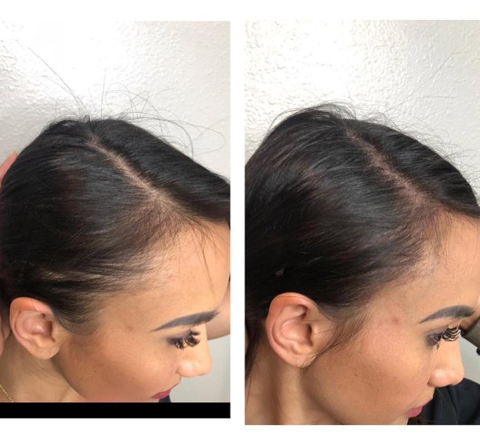 We helped this beautiful lady fix her thinning hair by giving her scalp micropigmentation.
