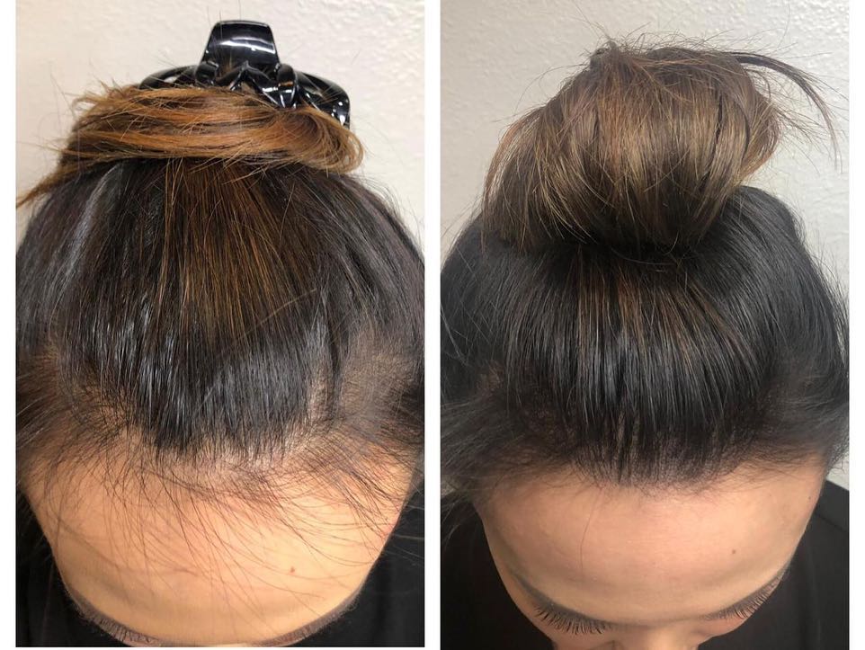 Fixing a client's thinning hair on the top of the head. The results look very natural.