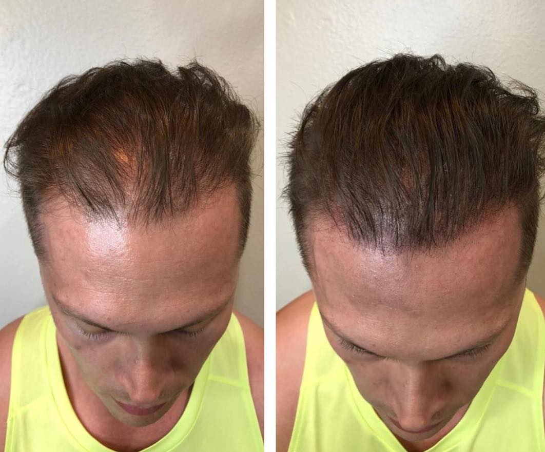 scalp-micropigmentation-las-vegas-hides-thinning-hair-receding