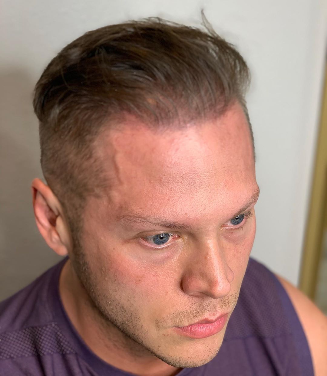A picture of one of our clients after having gotten scalp micropigmentation to fix his thinning hair