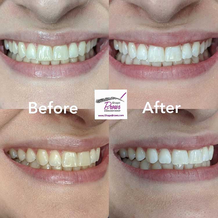 All-natural plant based teeth whitening for this client