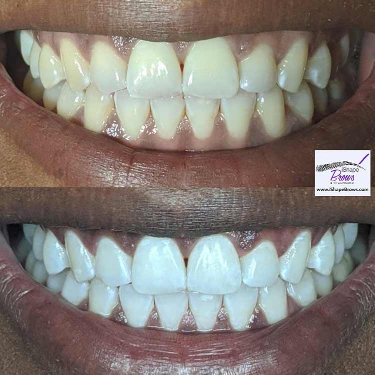 Teeth whitening for a client here at our las vegas shop